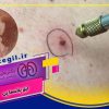 بهترین دکتر درمان فوری زگیل تناسلی در اصفهان