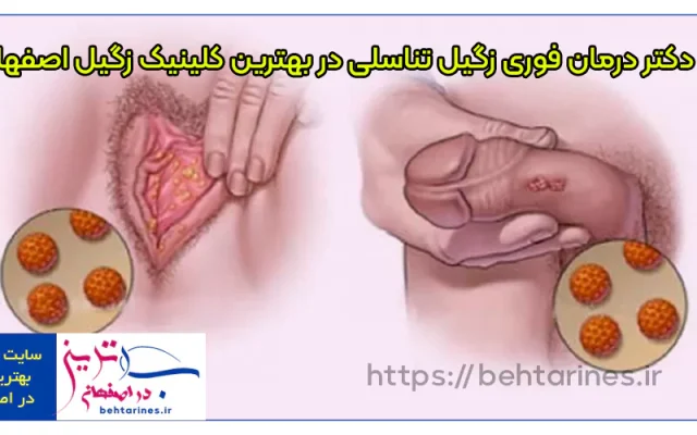 دکتر درمان فوری زگیل تناسلی در بهترین کلینیک زگیل اصفهان