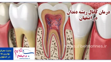 عصب کشی دندان و درمان کانال ریشه دندان در اصفهان