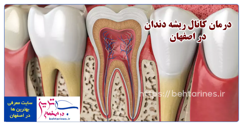 عصب کشی دندان و درمان کانال ریشه دندان در اصفهان