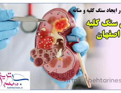 دکتر سنگ کلیه اصفهان – بهترین درمان خانگی و تشخیص علائم