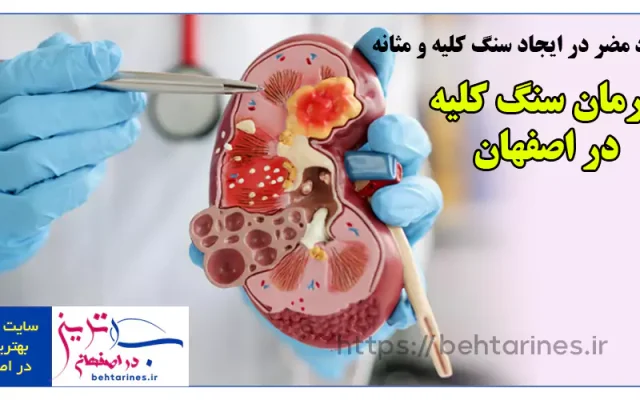 دکتر سنگ کلیه اصفهان – بهترین درمان خانگی و تشخیص علائم